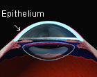 Epithelium Removal