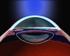 Excimer Laser Reshaping Cornea