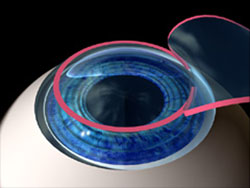 Treating Astigmatism