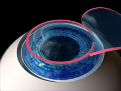 Treating Farsightedness