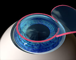 Treating Nearsightedness